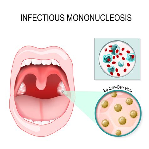 mononucleosis infecciosa-1